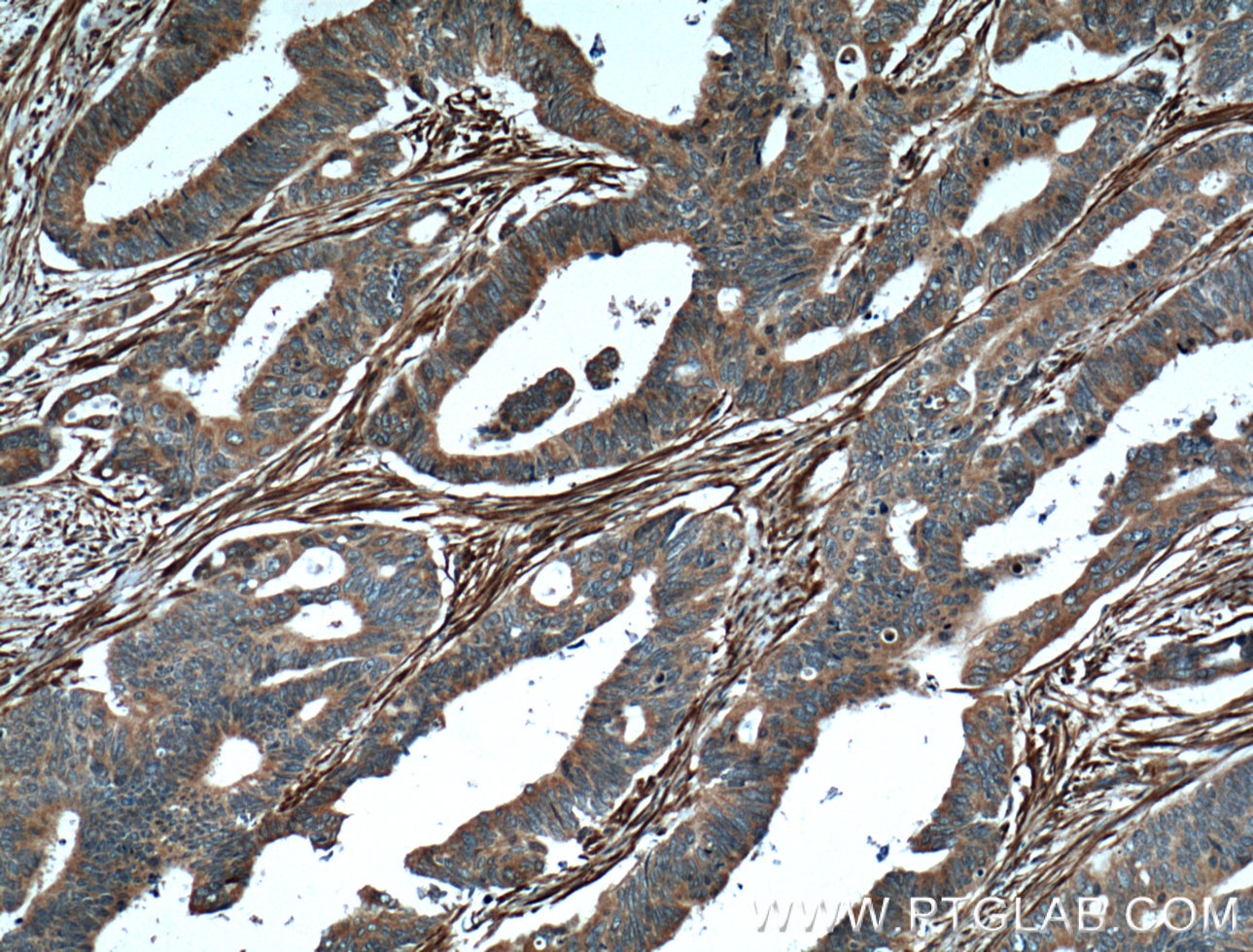 Immunohistochemistry (IHC) staining of human colon cancer tissue using Palladin Polyclonal antibody (10853-1-AP)