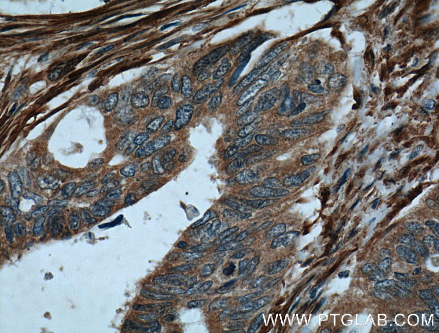 Immunohistochemistry (IHC) staining of human colon cancer tissue using Palladin Polyclonal antibody (10853-1-AP)