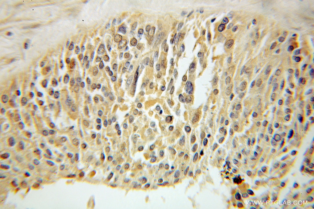 Immunohistochemistry (IHC) staining of human ovary tumor tissue using Palladin Polyclonal antibody (10853-1-AP)