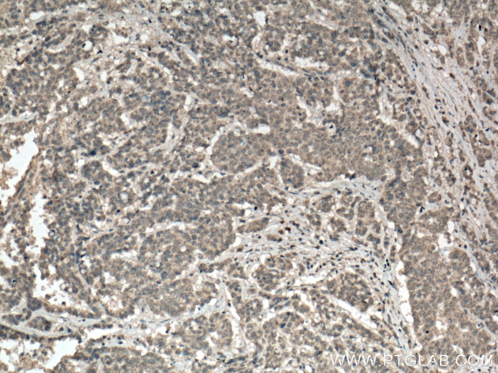 Immunohistochemistry (IHC) staining of human colon cancer tissue using PALLD,palladin Monoclonal antibody (66601-1-Ig)