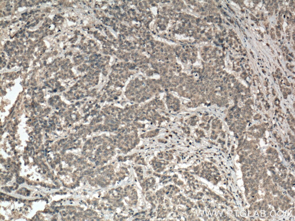 Immunohistochemistry (IHC) staining of human colon cancer tissue using Palladin Monoclonal antibody (66601-1-Ig)