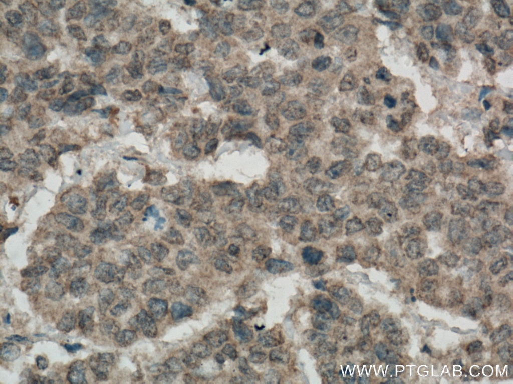 Immunohistochemistry (IHC) staining of human colon cancer tissue using Palladin Monoclonal antibody (66601-1-Ig)