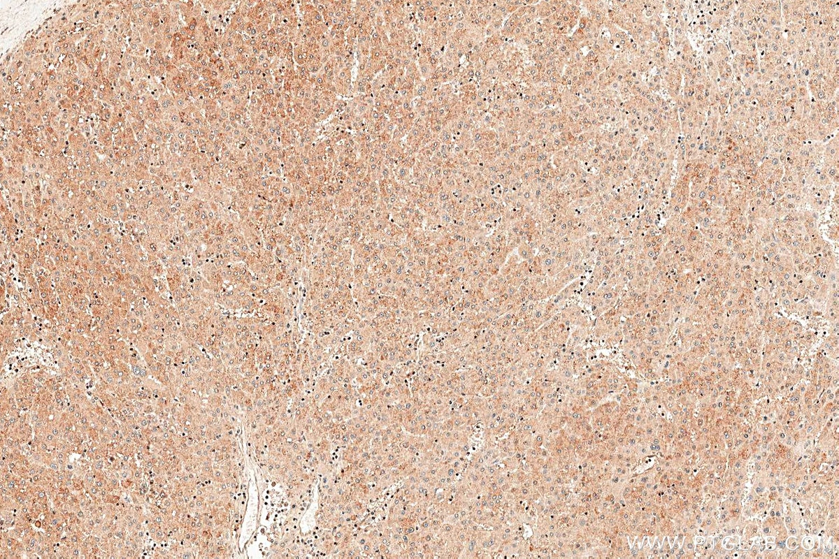 Immunohistochemistry (IHC) staining of human liver cancer tissue using PALMD Polyclonal antibody (16531-1-AP)