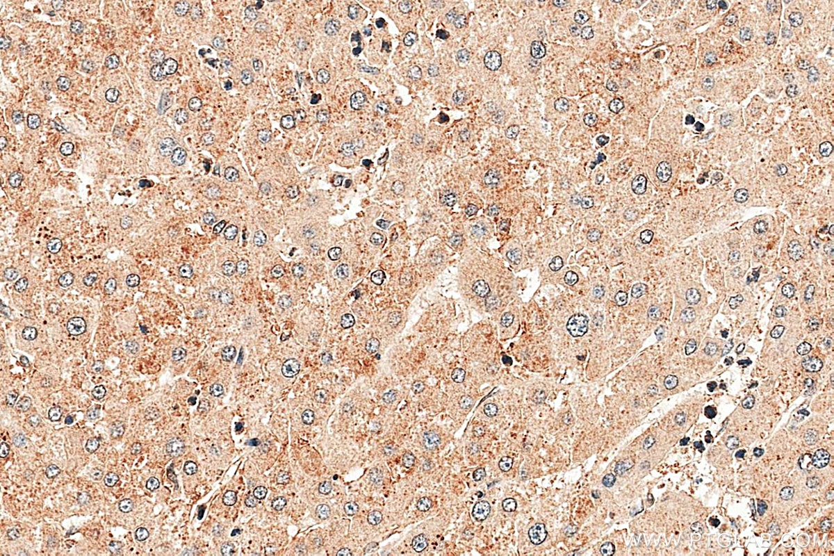 Immunohistochemistry (IHC) staining of human liver cancer tissue using PALMD Polyclonal antibody (16531-1-AP)