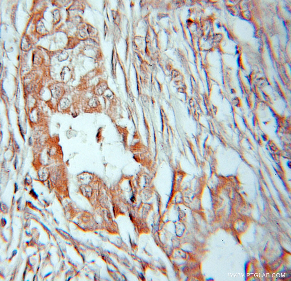Immunohistochemistry (IHC) staining of human lung cancer tissue using PANK2 Polyclonal antibody (11001-1-AP)