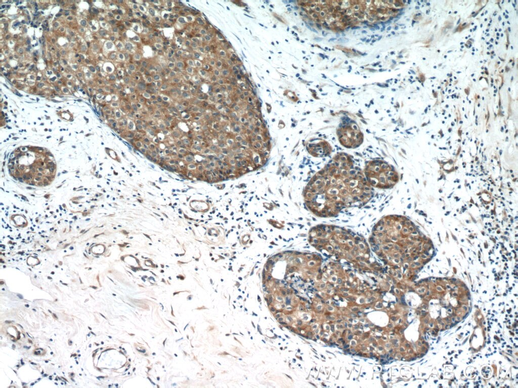 IHC staining of human breast cancer using 12466-1-AP