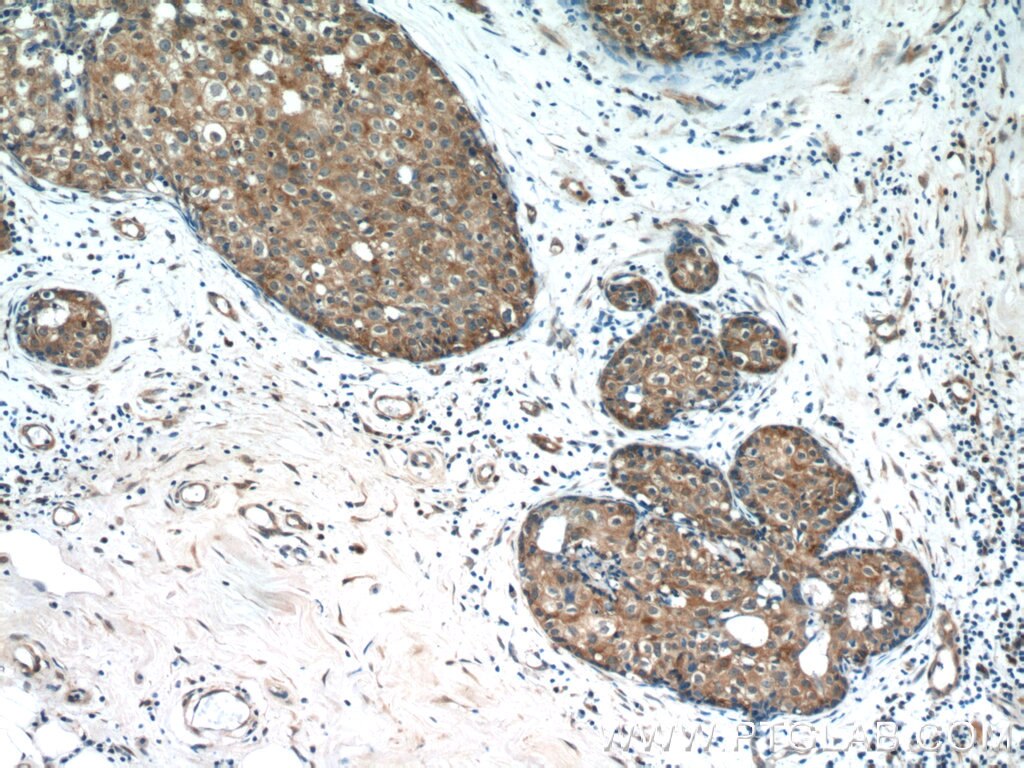 Immunohistochemistry (IHC) staining of human breast cancer tissue using PANK1/2/3 Polyclonal antibody (12466-1-AP)