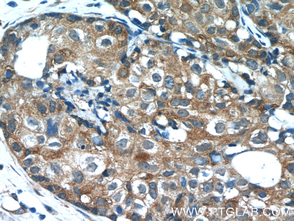 Immunohistochemistry (IHC) staining of human breast cancer tissue using PANK1/2/3 Polyclonal antibody (12466-1-AP)