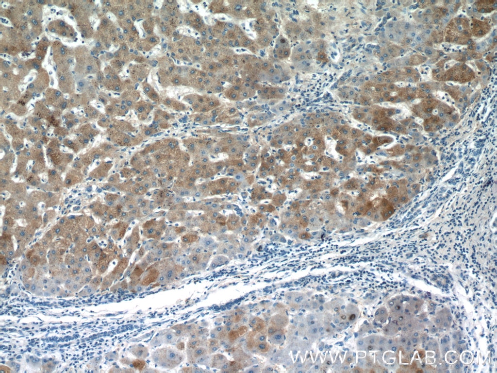 Immunohistochemistry (IHC) staining of human hepatocirrhosis tissue using PANK1/2/3 Polyclonal antibody (12466-1-AP)