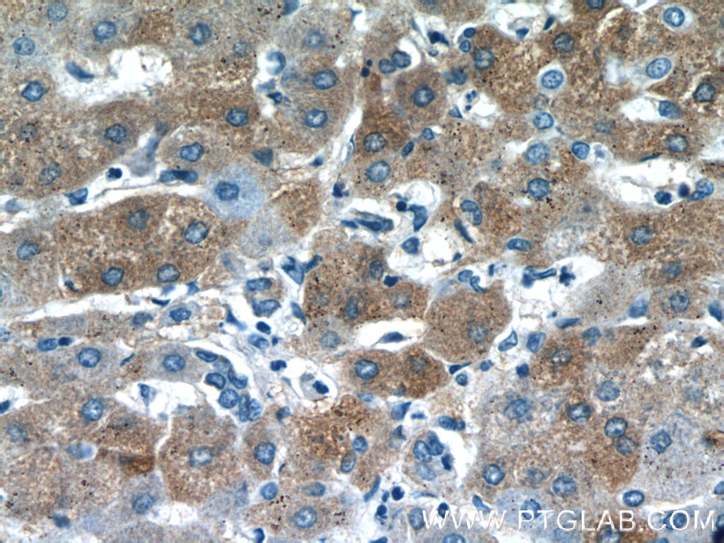 Immunohistochemistry (IHC) staining of human hepatocirrhosis tissue using PANK1/2/3 Polyclonal antibody (12466-1-AP)