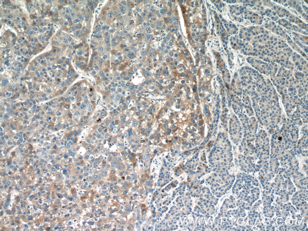 Immunohistochemistry (IHC) staining of human liver cancer tissue using PANK1/2/3 Polyclonal antibody (12466-1-AP)