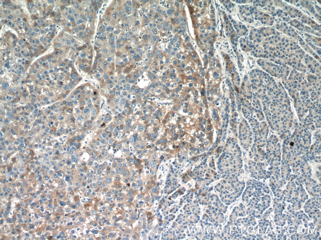 IHC staining of human liver cancer using 12466-1-AP