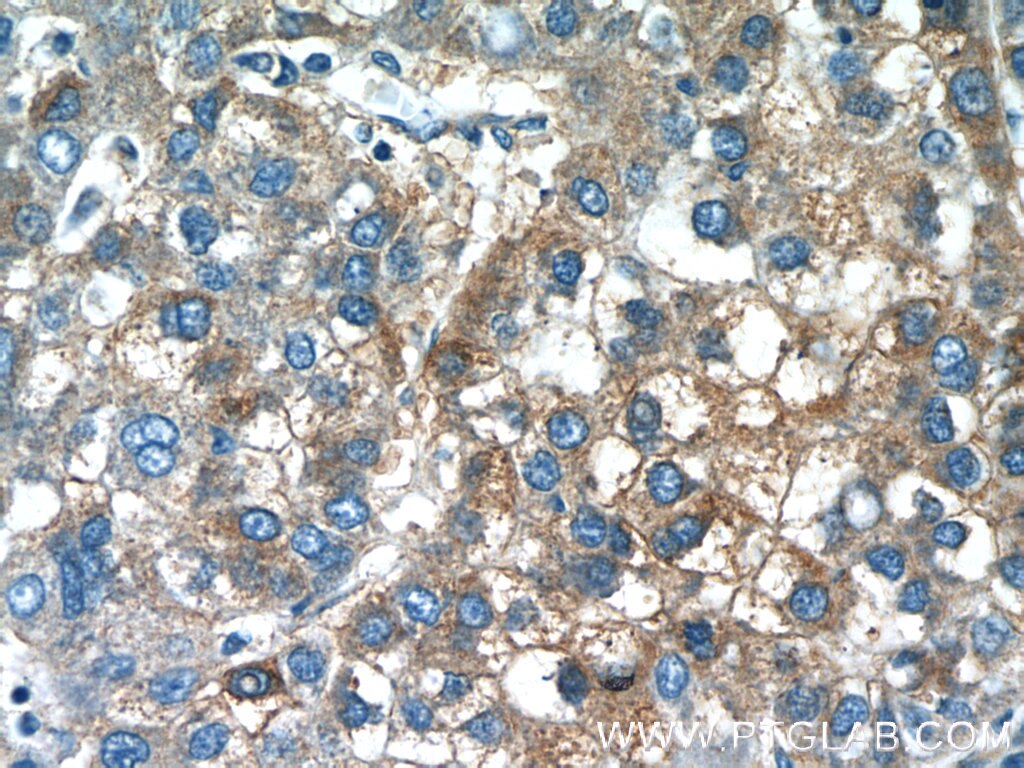 Immunohistochemistry (IHC) staining of human liver cancer tissue using PANK1/2/3 Polyclonal antibody (12466-1-AP)