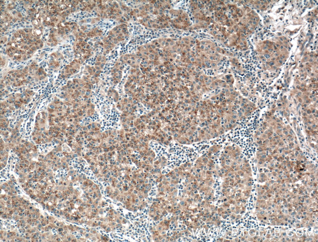 Immunohistochemistry (IHC) staining of human liver cancer tissue using PANK1/2/3 Polyclonal antibody (12466-1-AP)