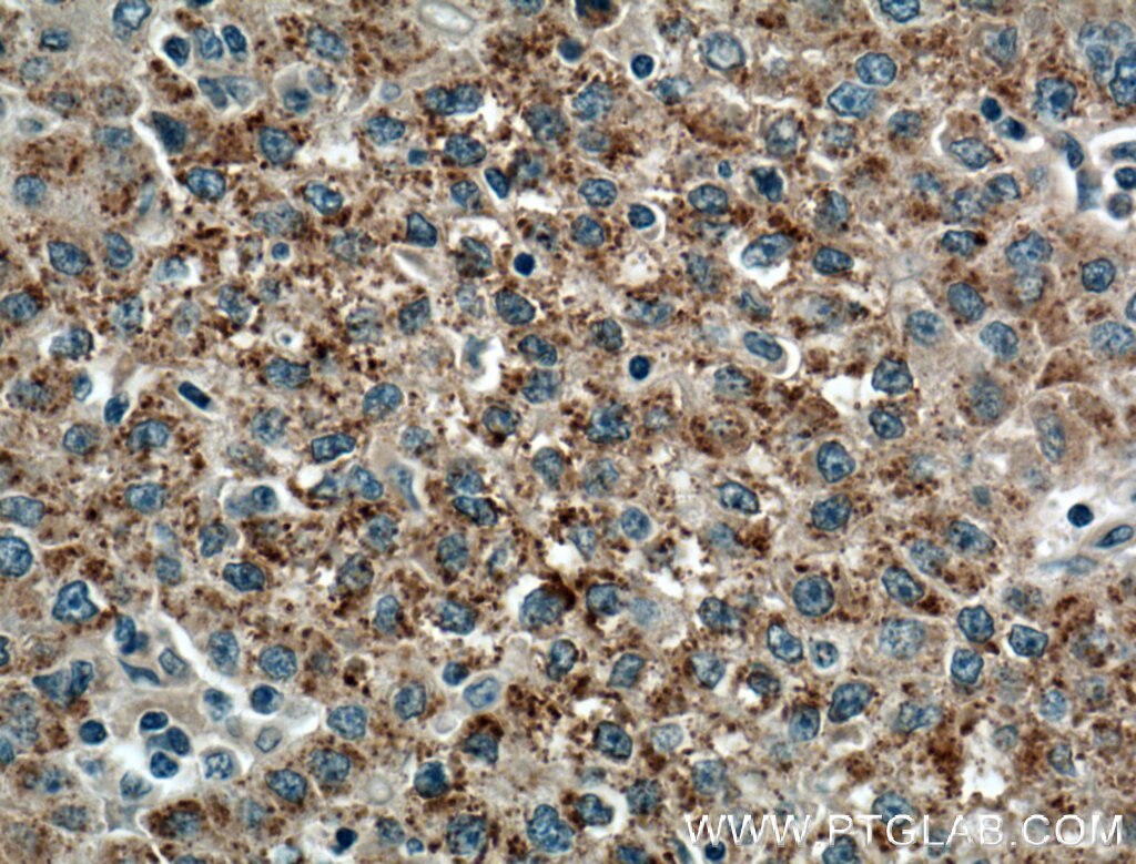 Immunohistochemistry (IHC) staining of human liver cancer tissue using PANK1/2/3 Polyclonal antibody (12466-1-AP)