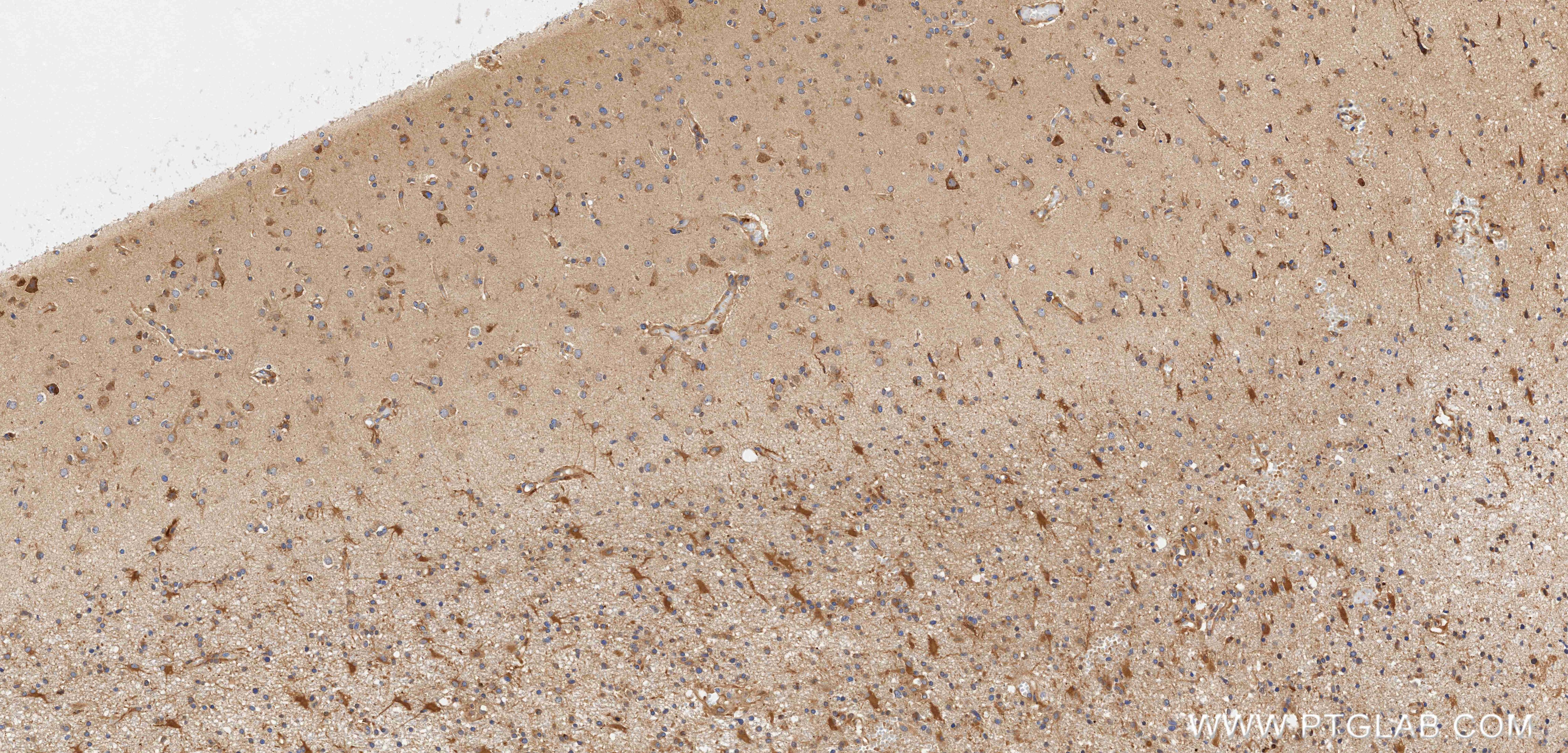 Immunohistochemistry (IHC) staining of Human brain cancer（Astrocitoma） using Anti-Human PANX2 Rabbit Recombinant Antibody (98696-1-RR)