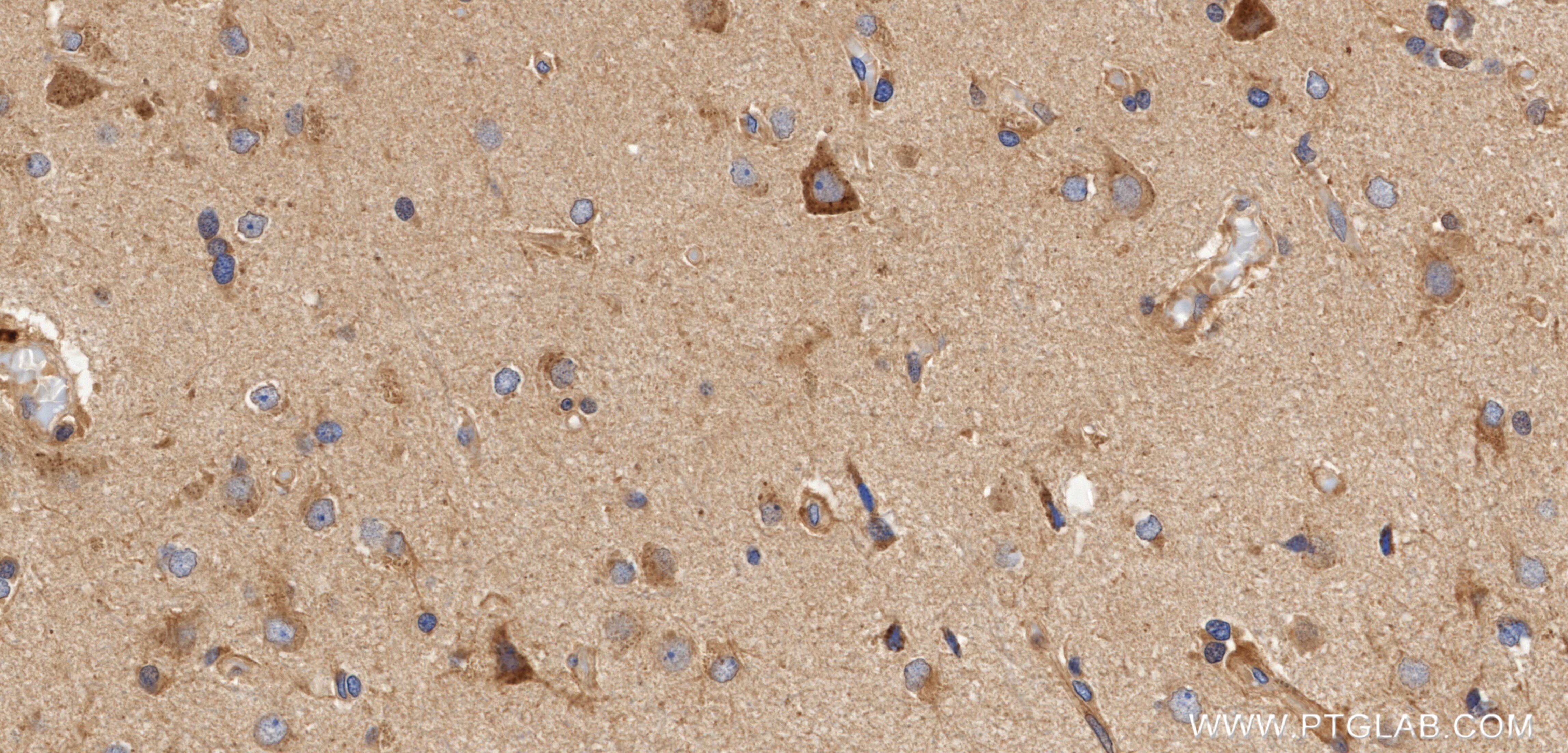 Immunohistochemistry (IHC) staining of Human brain cancer（Astrocitoma） using Anti-Human PANX2 Rabbit Recombinant Antibody (98696-1-RR)