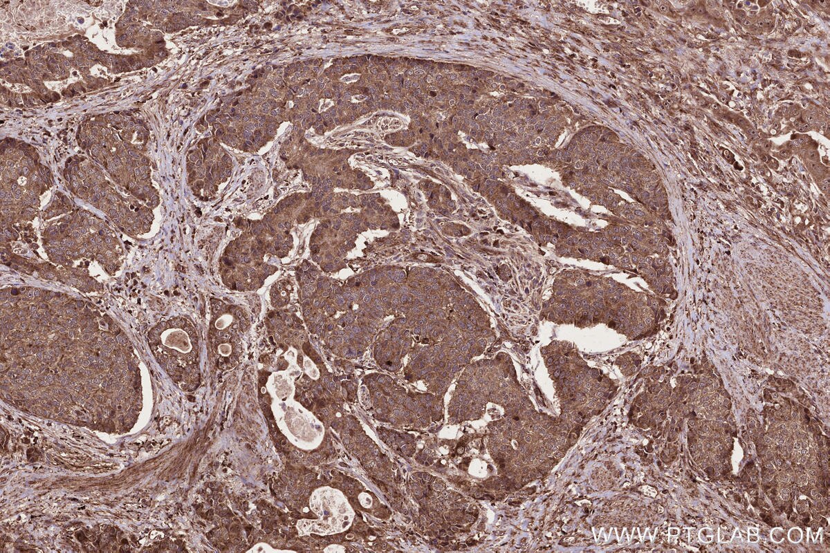 Immunohistochemistry (IHC) staining of human stomach cancer tissue using PAPD5 Polyclonal antibody (55197-1-AP)