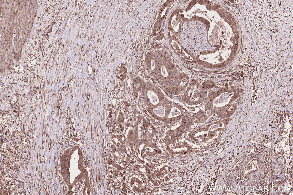 Immunohistochemistry (IHC) staining of human stomach cancer tissue using PAPD5 Polyclonal antibody (55197-1-AP)