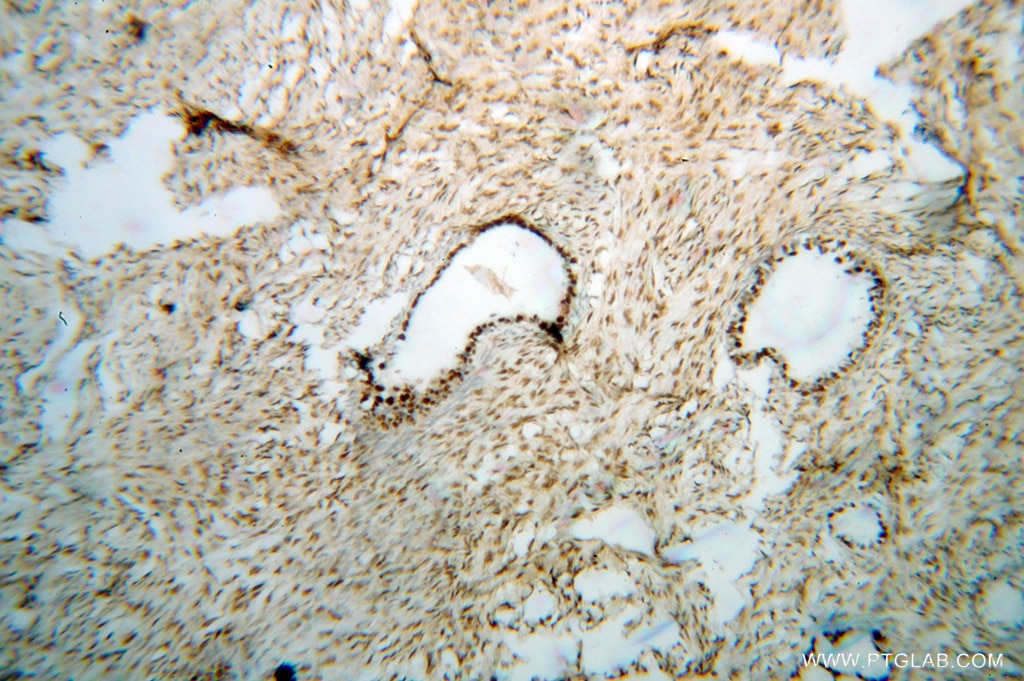Immunohistochemistry (IHC) staining of human ovary tumor tissue using PAPSS1 Polyclonal antibody (14708-1-AP)