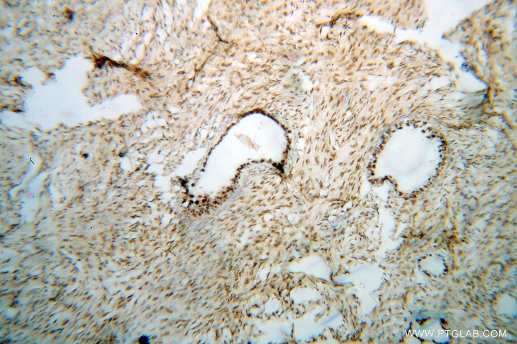 IHC staining of human ovary tumor using 14708-1-AP