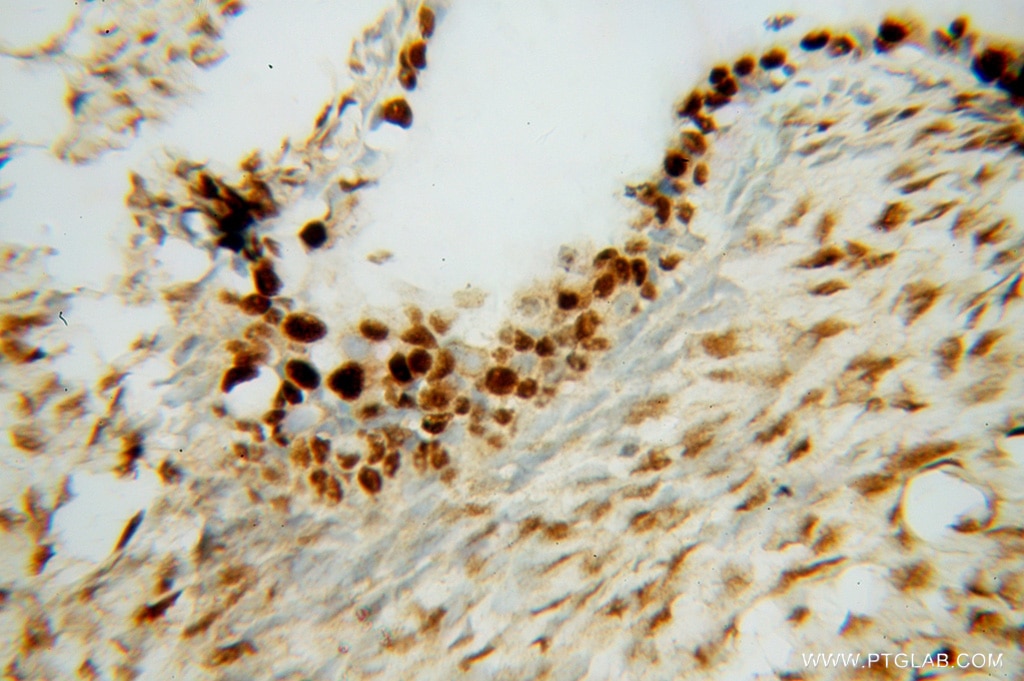Immunohistochemistry (IHC) staining of human ovary tumor tissue using PAPSS1 Polyclonal antibody (14708-1-AP)