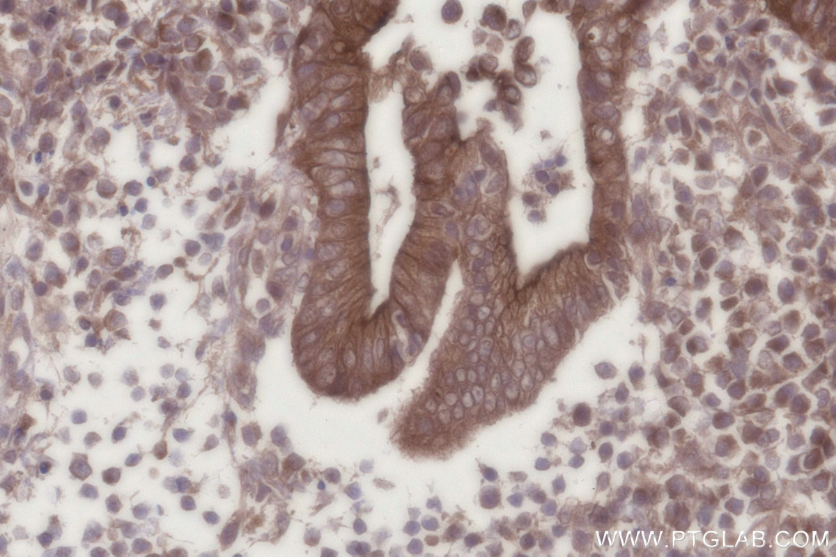 Immunohistochemistry (IHC) staining of human appendicitis tissue using PARD3 Polyclonal antibody (11085-1-AP)