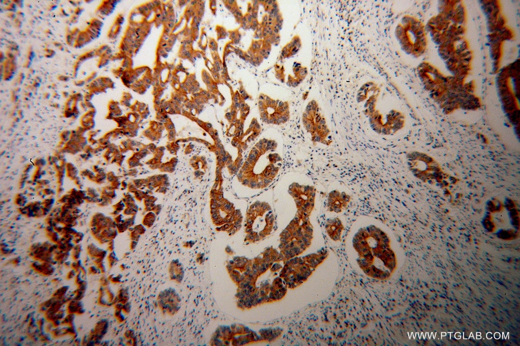 Immunohistochemistry (IHC) staining of human colon cancer tissue using PARD3 Polyclonal antibody (11085-1-AP)