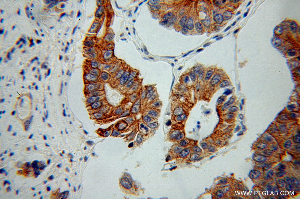 Immunohistochemistry (IHC) staining of human colon cancer tissue using PARD3 Polyclonal antibody (11085-1-AP)