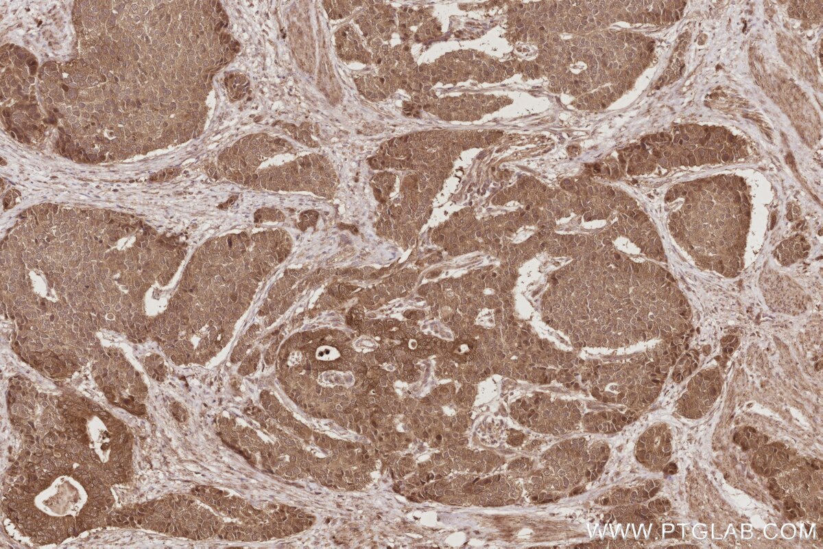 Immunohistochemistry (IHC) staining of human stomach cancer tissue using PARD6B Polyclonal antibody (13996-1-AP)