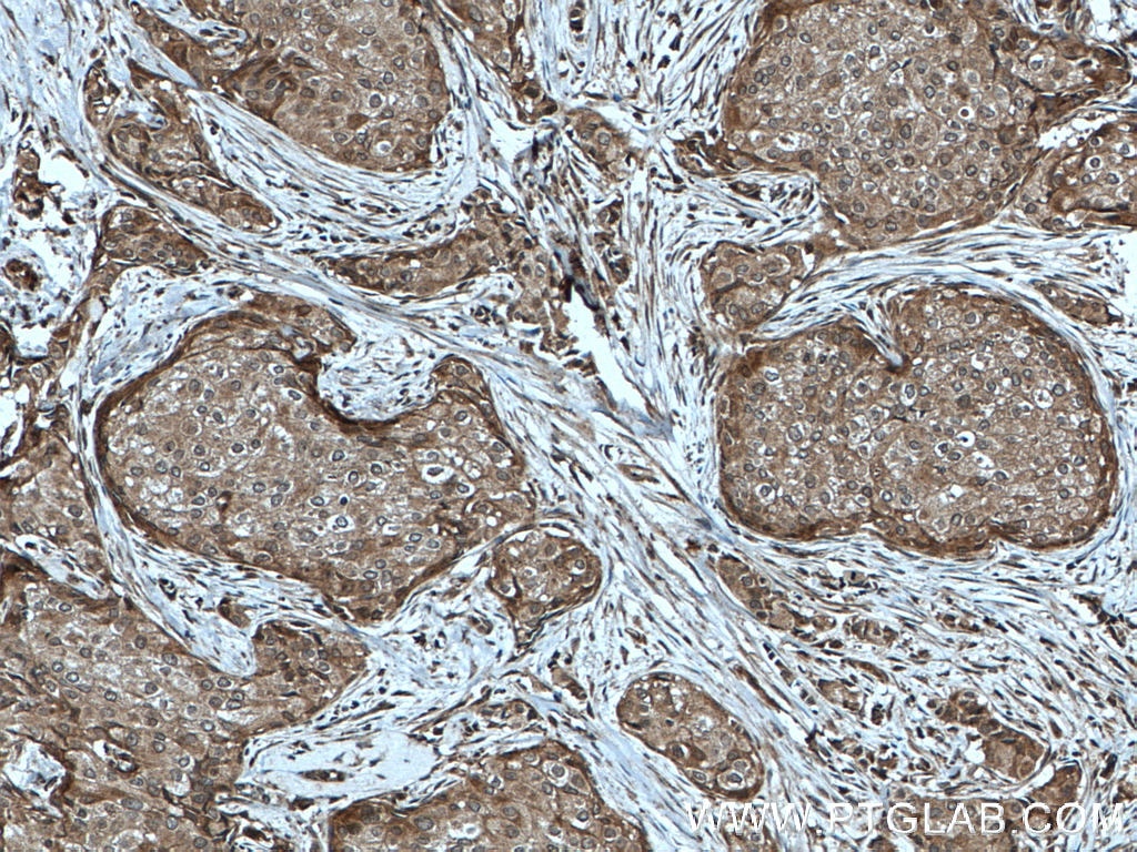 Immunohistochemistry (IHC) staining of human breast cancer tissue using PARG Polyclonal antibody (27808-1-AP)