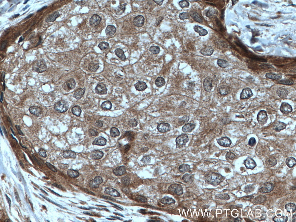 Immunohistochemistry (IHC) staining of human breast cancer tissue using PARG Polyclonal antibody (27808-1-AP)