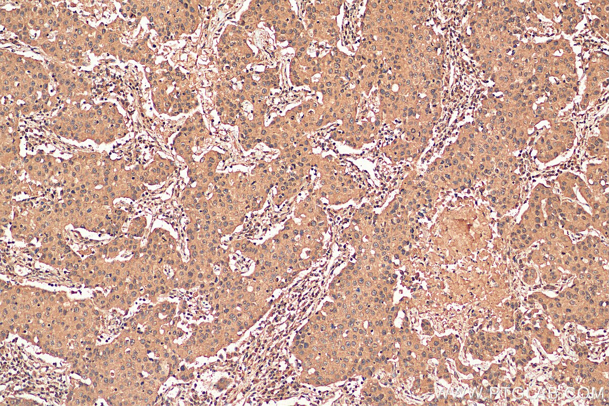 Immunohistochemistry (IHC) staining of human breast cancer tissue using PARG Monoclonal antibody (67946-1-Ig)