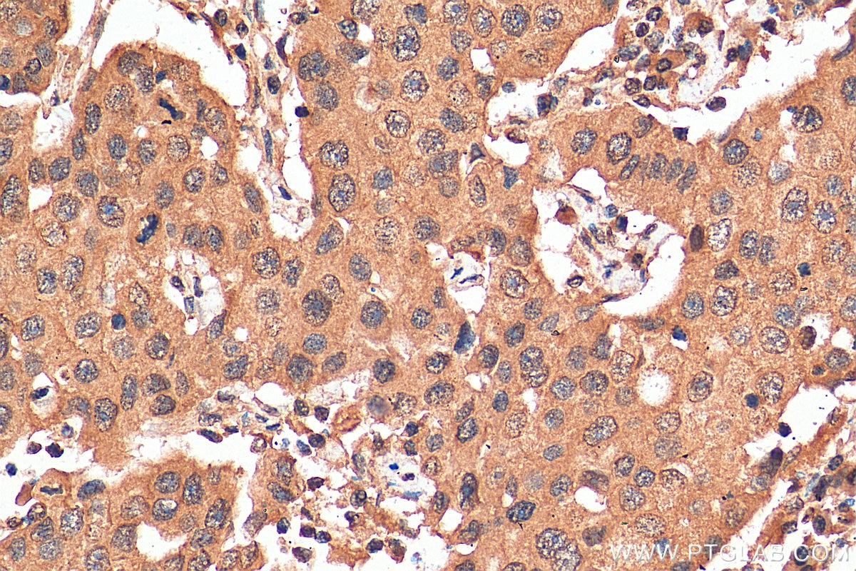 Immunohistochemistry (IHC) staining of human breast cancer tissue using PARG Monoclonal antibody (67946-1-Ig)