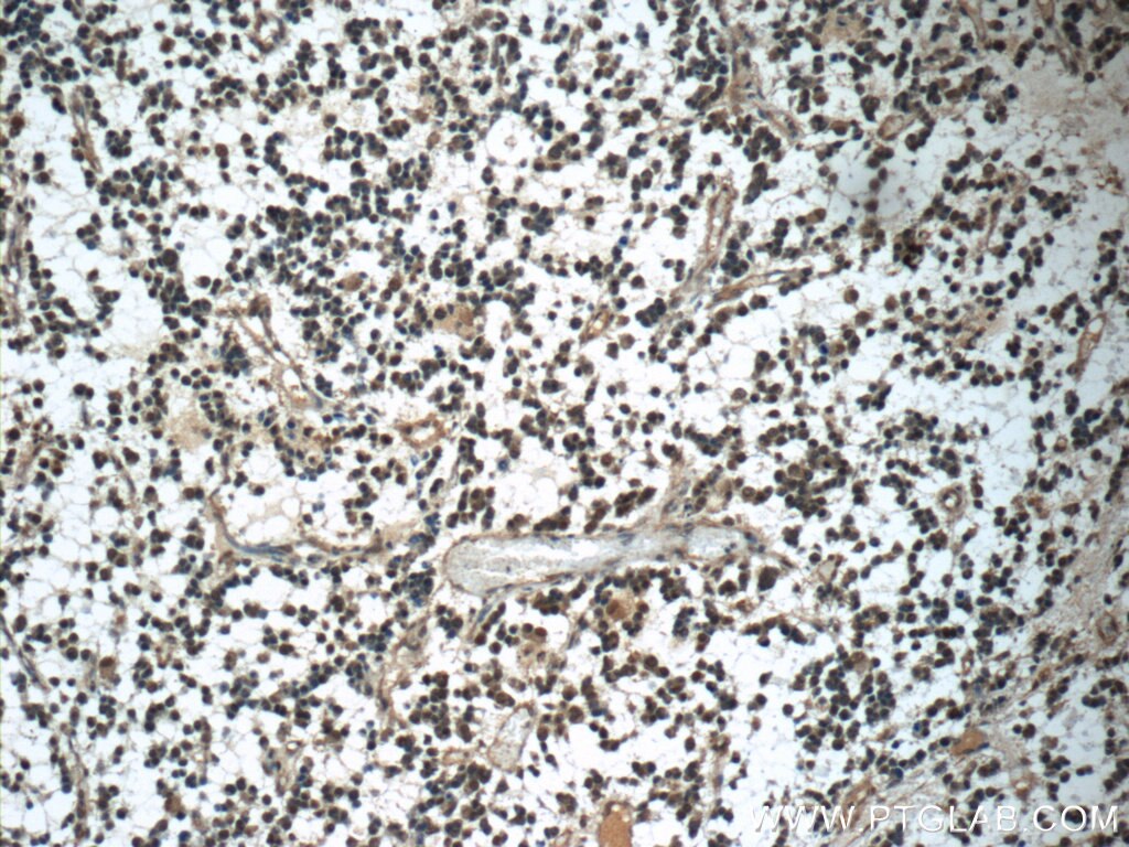 Immunohistochemistry (IHC) staining of human gliomas tissue using PARK7,DJ-1 Polyclonal antibody (11681-1-AP)