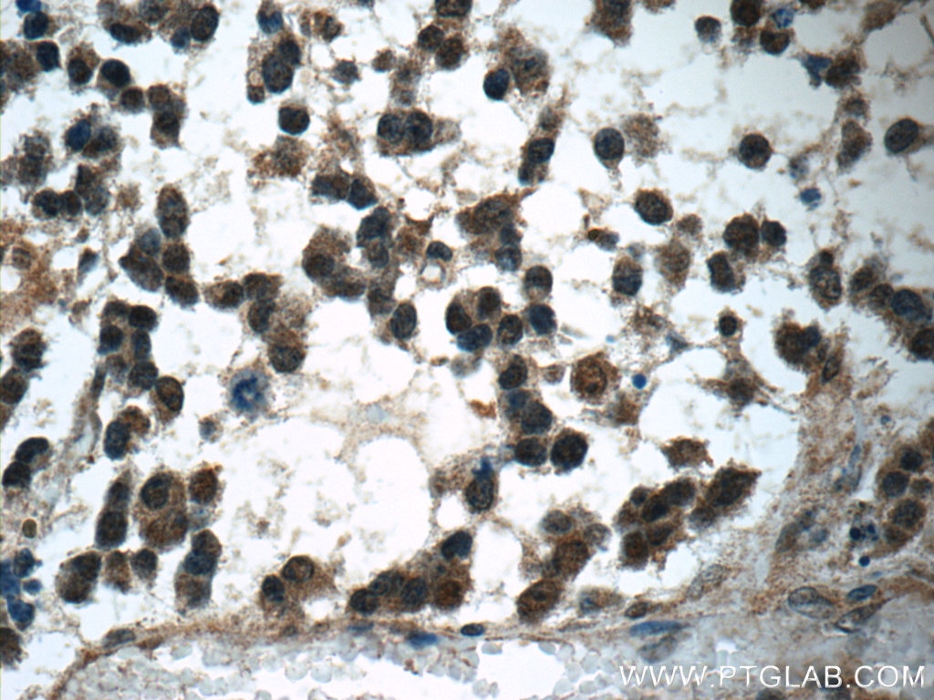 Immunohistochemistry (IHC) staining of human gliomas tissue using PARK7,DJ-1 Polyclonal antibody (11681-1-AP)