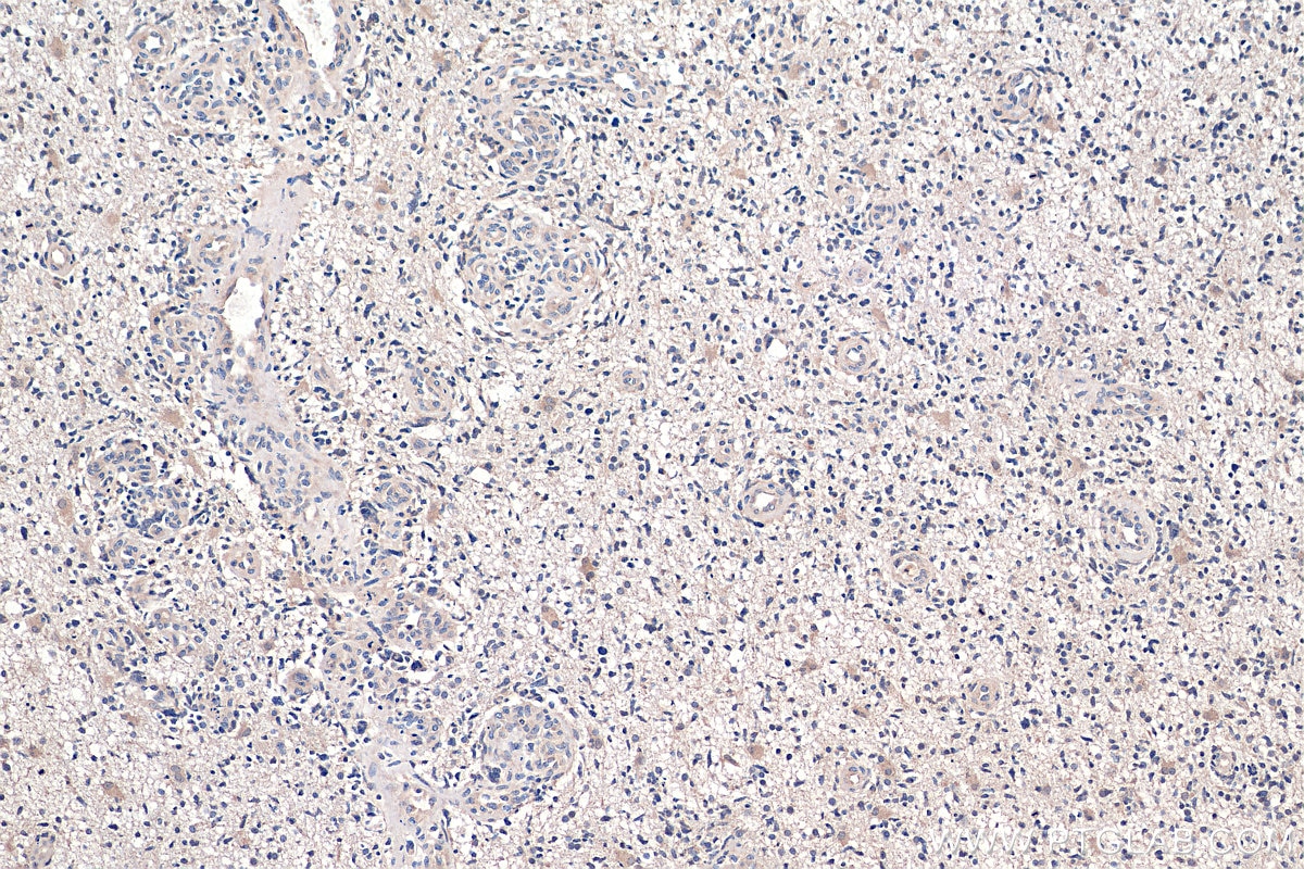 Immunohistochemistry (IHC) staining of human gliomas tissue using PARK7,DJ-1 Polyclonal antibody (11681-1-AP)