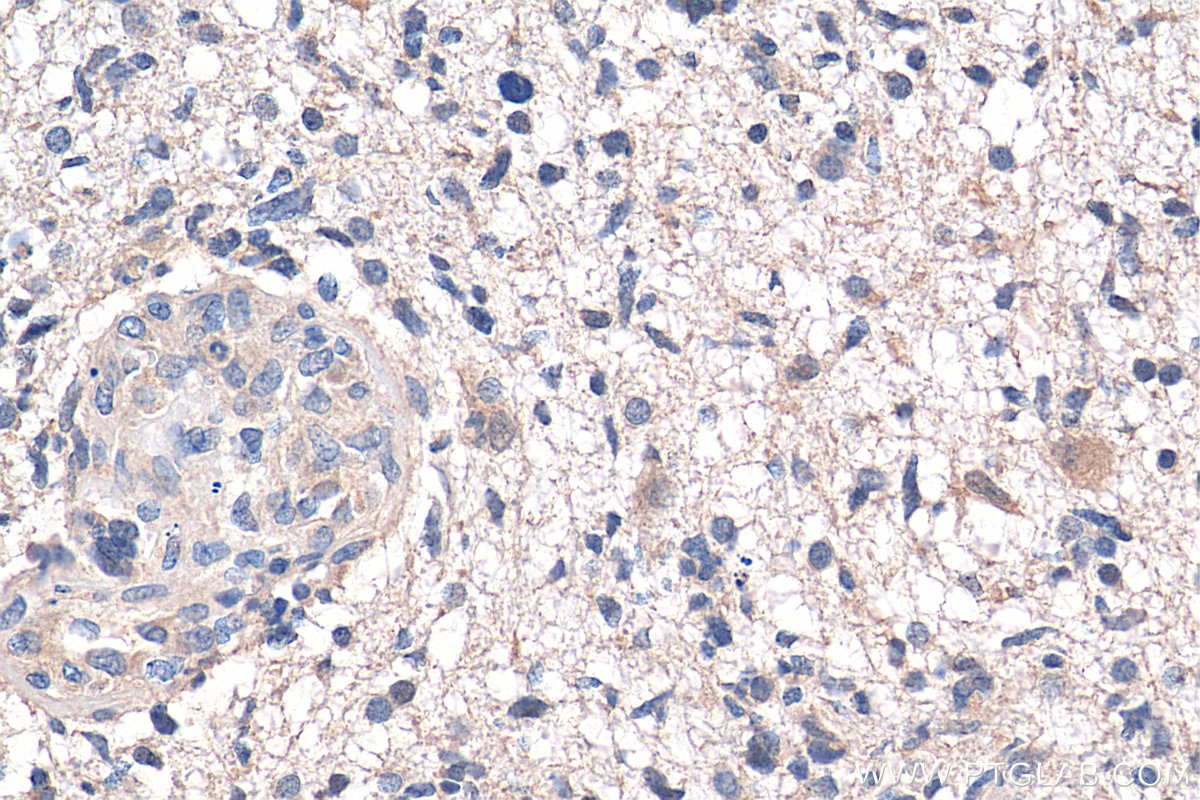 Immunohistochemistry (IHC) staining of human gliomas tissue using PARK7/DJ-1 Polyclonal antibody (11681-1-AP)