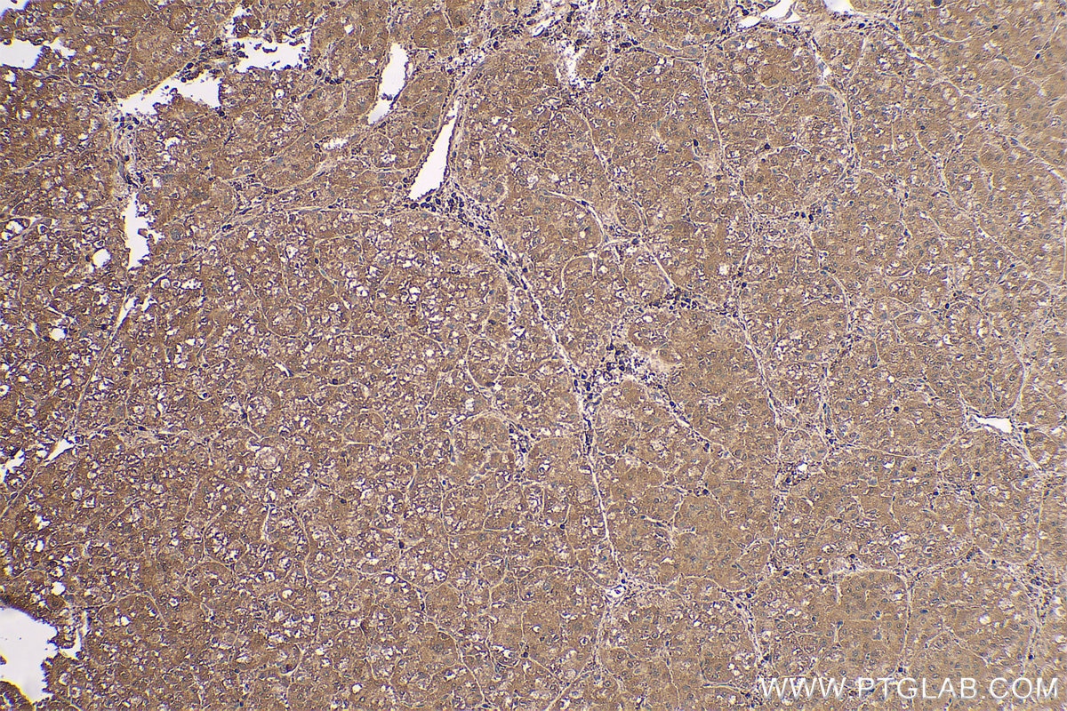 Immunohistochemistry (IHC) staining of human liver cancer tissue using PARK7,DJ-1 Polyclonal antibody (11681-1-AP)