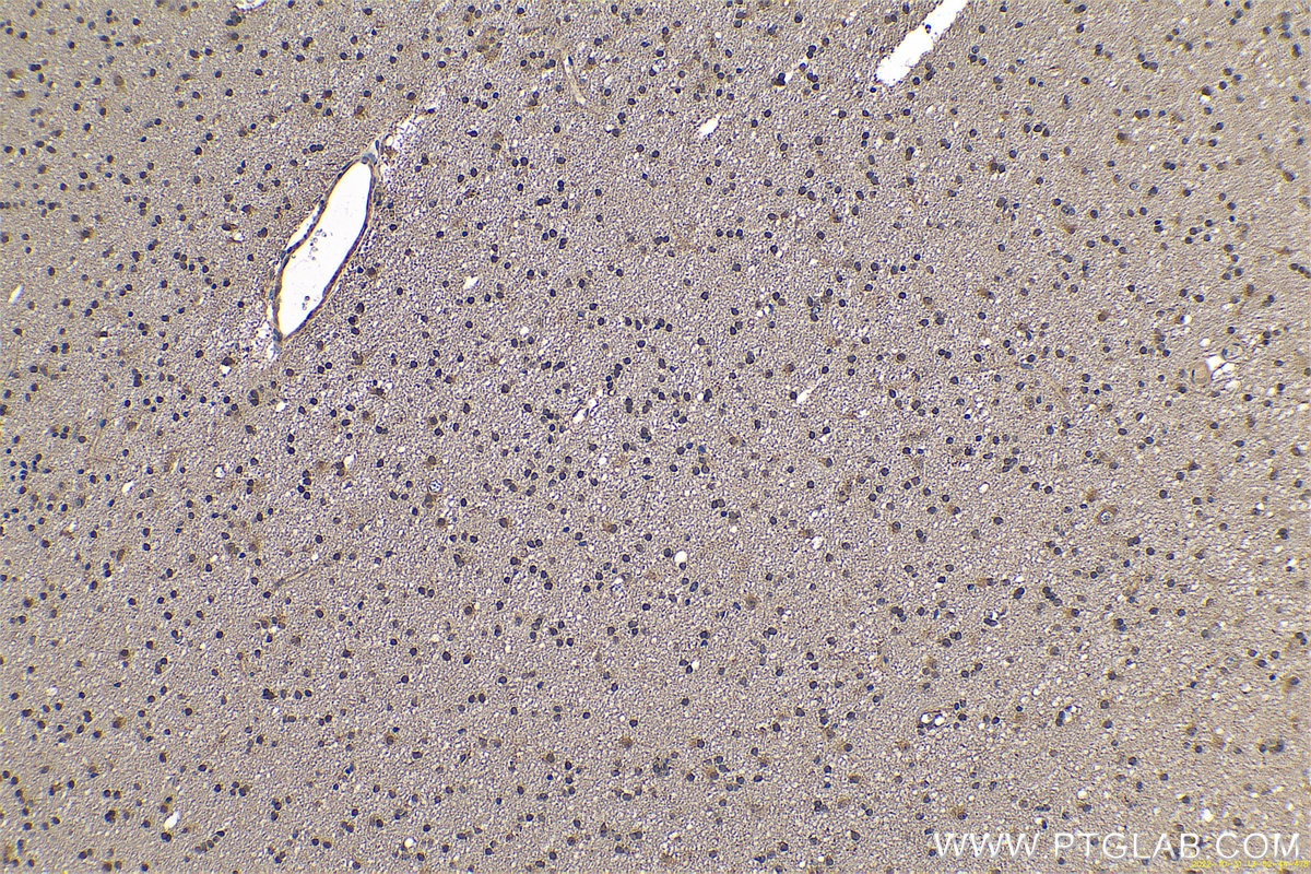 Immunohistochemistry (IHC) staining of human gliomas tissue using PARK7,DJ-1 Polyclonal antibody (11681-1-AP)