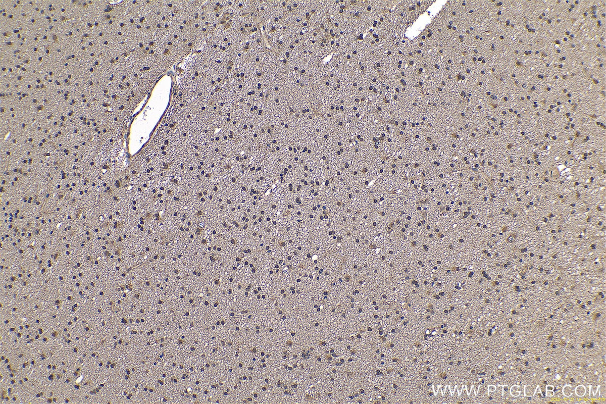 IHC staining of human gliomas using 11681-1-AP