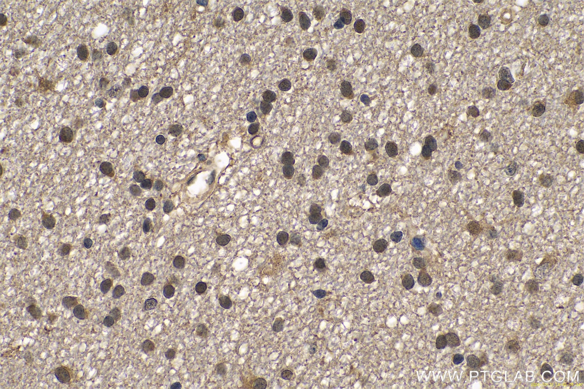 Immunohistochemistry (IHC) staining of human gliomas tissue using PARK7,DJ-1 Polyclonal antibody (11681-1-AP)