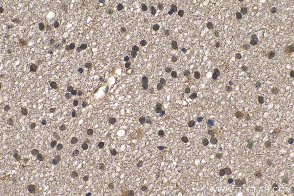 IHC staining of human gliomas using 11681-1-AP