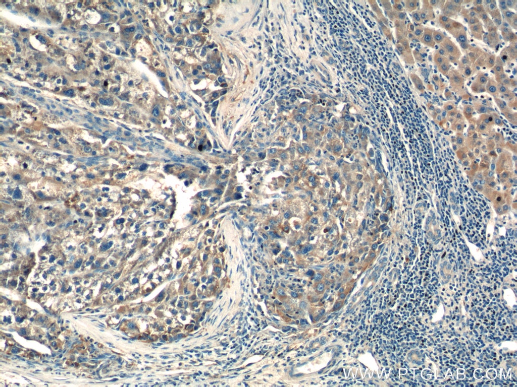Immunohistochemistry (IHC) staining of human liver cancer tissue using PARL Polyclonal antibody (26679-1-AP)
