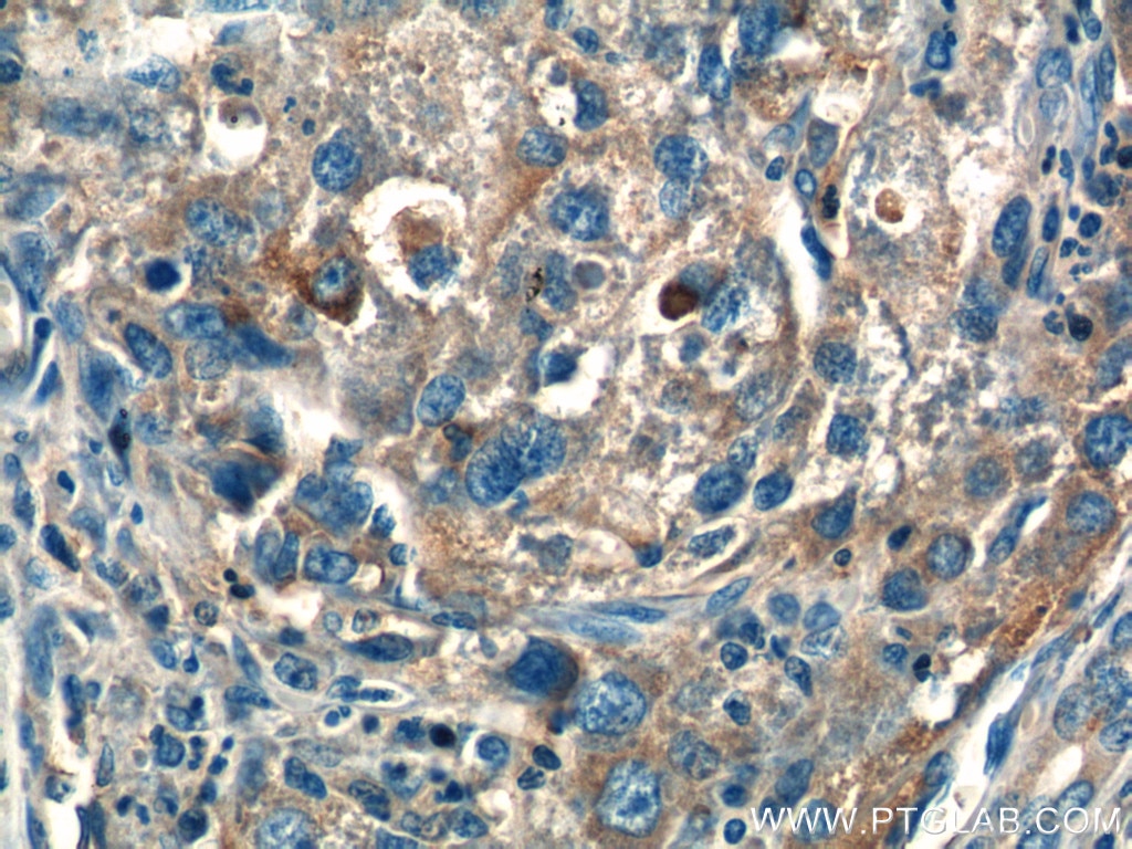 IHC staining of human liver cancer using 26679-1-AP