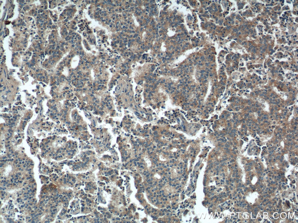 Immunohistochemistry (IHC) staining of human prostate cancer tissue using PARL Polyclonal antibody (26679-1-AP)