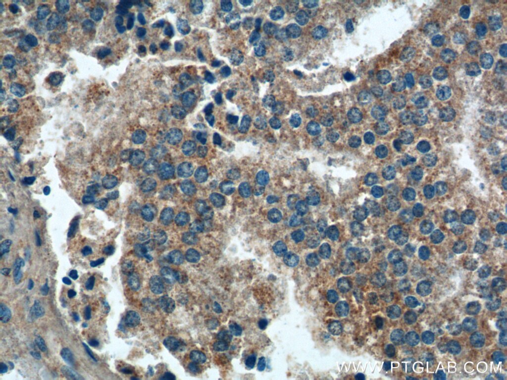 Immunohistochemistry (IHC) staining of human prostate cancer tissue using PARL Polyclonal antibody (26679-1-AP)