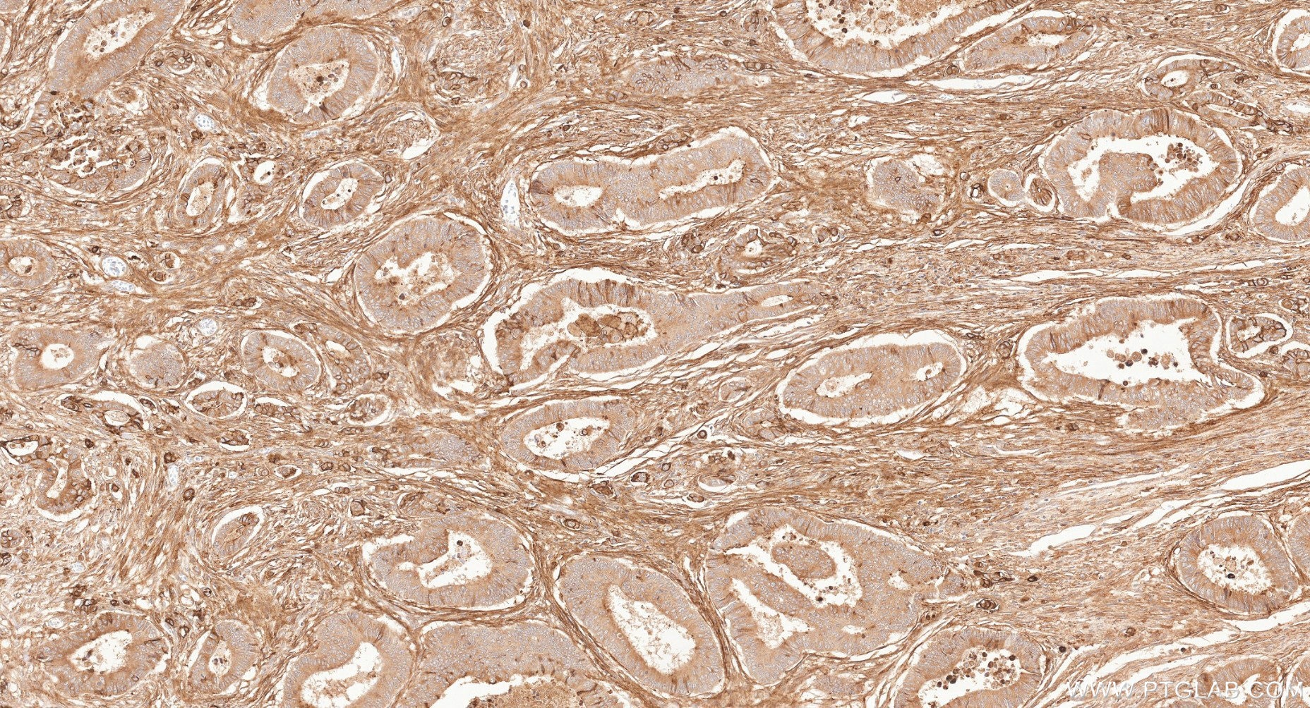 IHC staining of human colon cancer using 87241-3-RR (same clone as 87241-3-PBS) Immunohistochemistry (IHC) staining of human colon cancer tissue using PARM1 Recombinant monoclonal antibody (87241-3-RR)