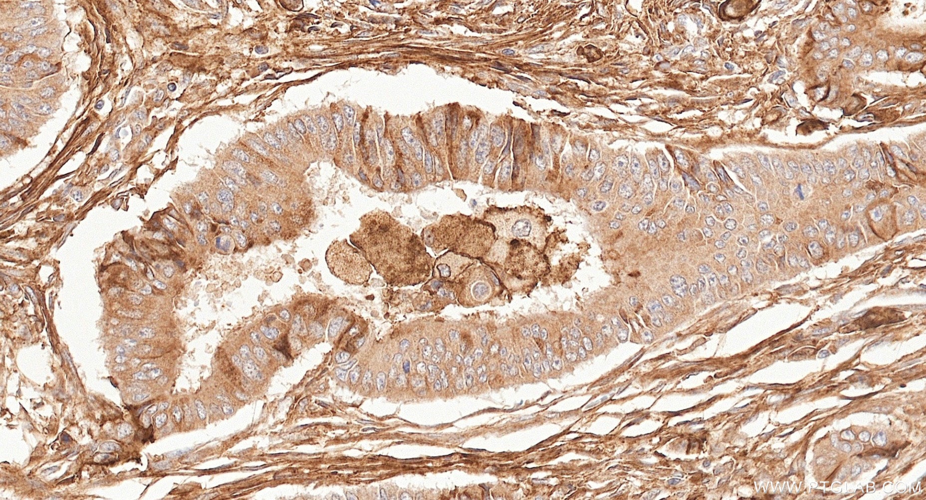 IHC staining of human colon cancer using 87241-3-RR (same clone as 87241-3-PBS) Immunohistochemistry (IHC) staining of human colon cancer tissue using PARM1 Recombinant monoclonal antibody (87241-3-RR)