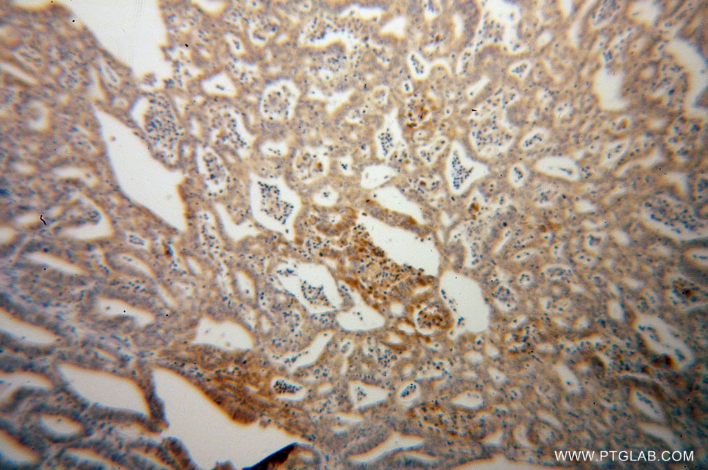 Immunohistochemistry (IHC) staining of human endometrial cancer tissue using PARN Polyclonal antibody (13799-1-AP)